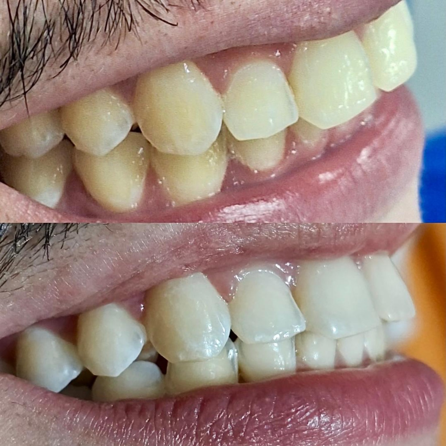 Depois do clareamento dental