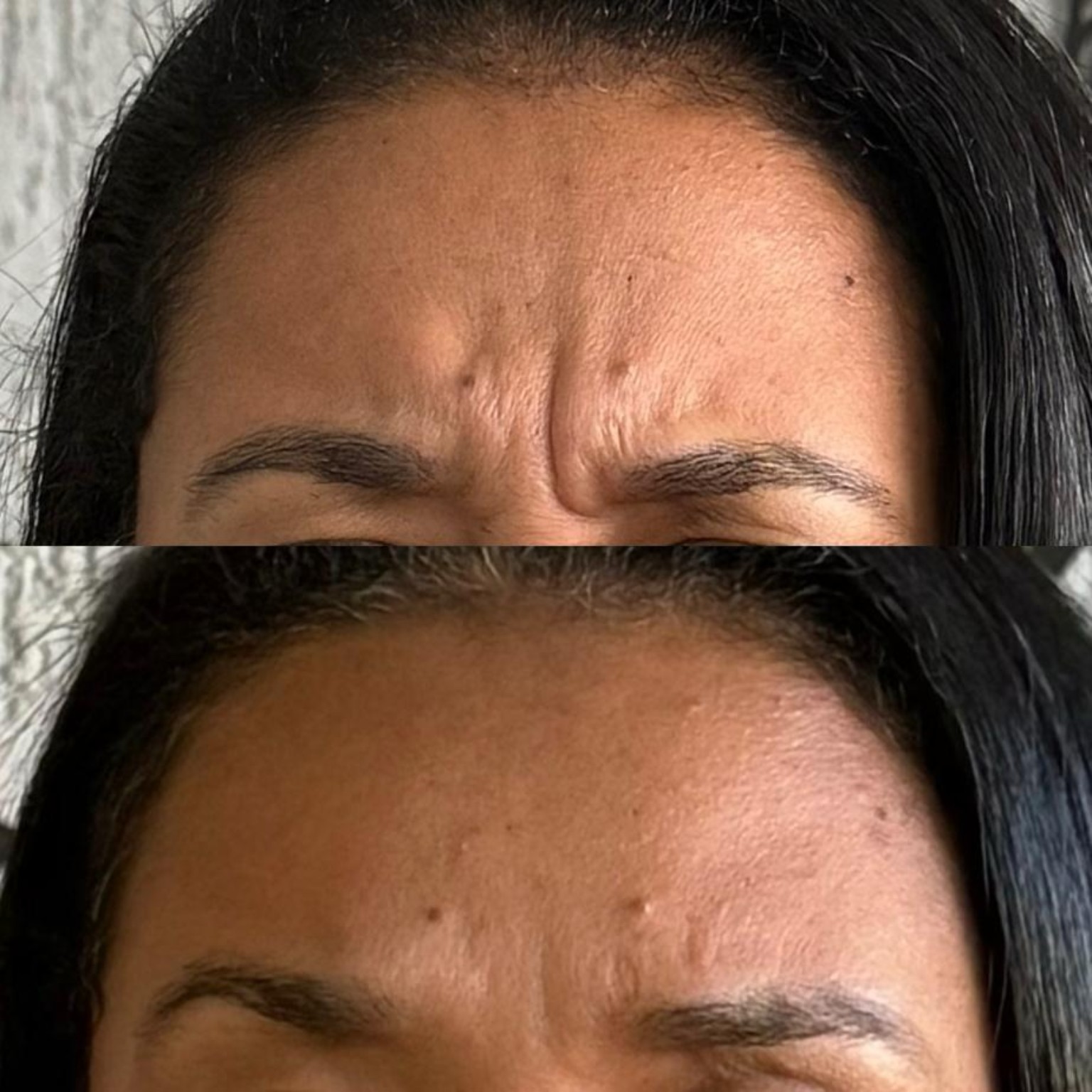 Antes da harmonização facial