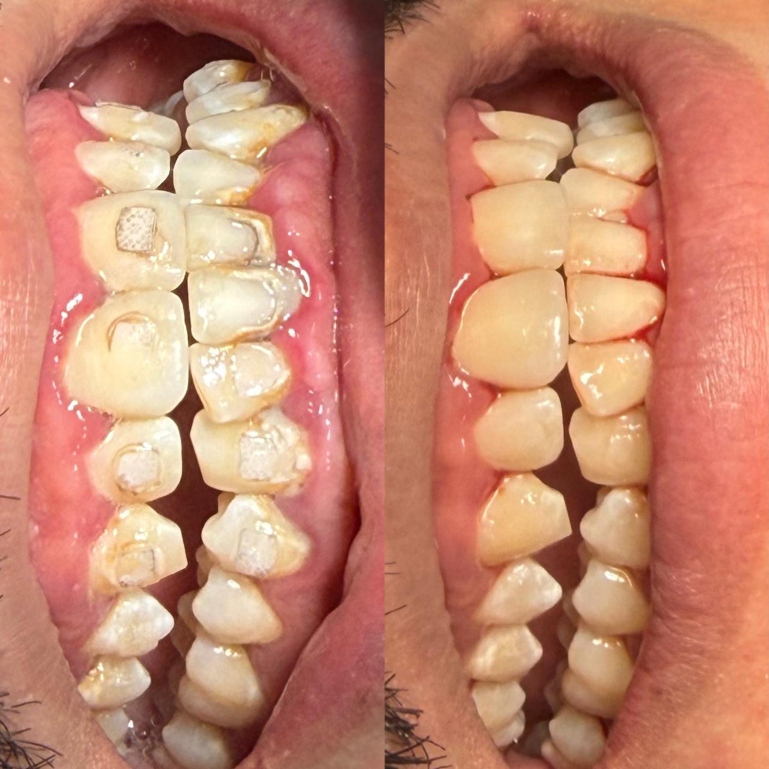Depois da restauração estética